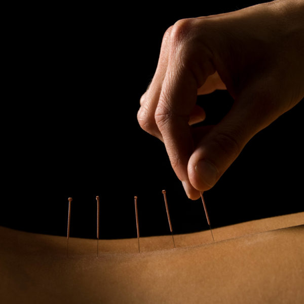 Acupuncture in Salem, OR Whitmire Chiropractic